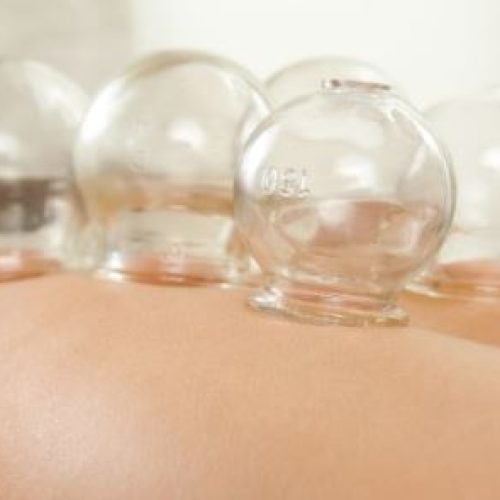Cupping